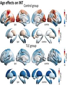 Atypical intrinsic neural timescales in temporal lobe epilepsy image