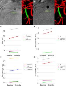 The effect of intensive statin therapy in non-symptomatic intracranial arteries: The STAMINA-MRI sub-study image