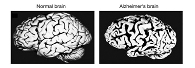 Alzheimer’s brain changes